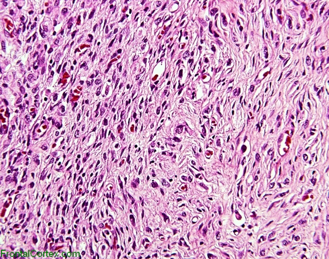 Desmoplastic infantile astrocytoma, H&E stain x100